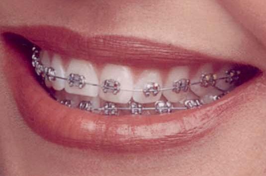 Metal Braces