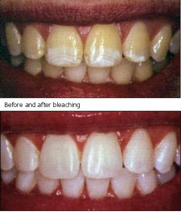 Bleaching