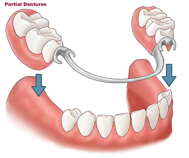 Partial Denture